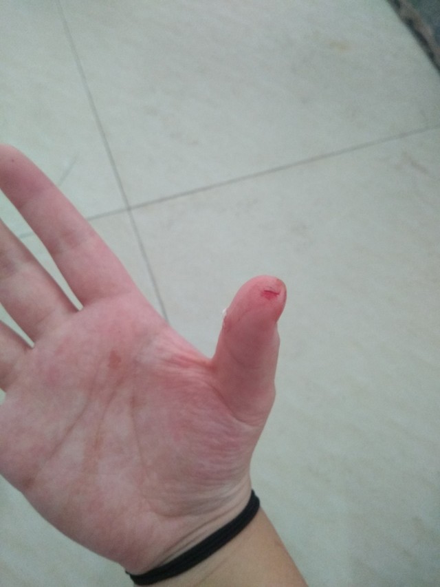 打字也挺疼的,所以今天更新速度回慢很多,因为食指实在是没有大拇指好